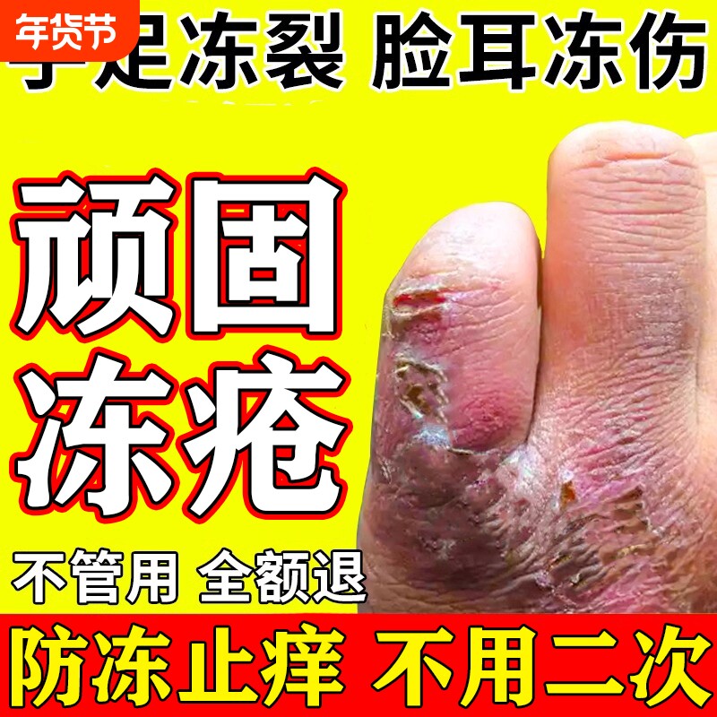 冻疮膏止痒冻伤膏正品排行榜第一名防足裂手指裂口干皴裂修复膏M