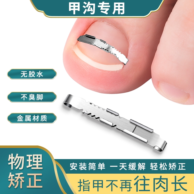 【无感矫正嵌甲】不再扎肉