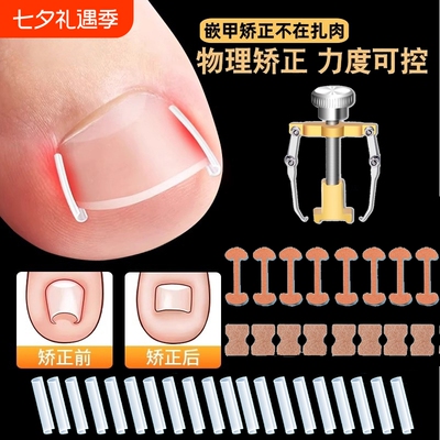 甲沟矫正器嵌甲贴片炎防脚指甲往肉里长专用工具隔离垫片神器趾甲