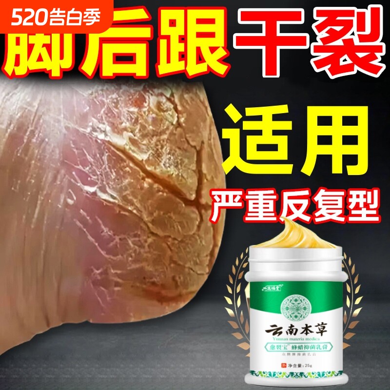 脚后跟干裂防脚裂手指裂口龟裂干燥足底起皮皴裂马油膏身体护理乳