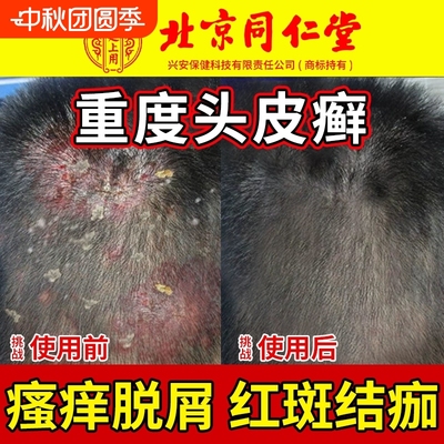 北京同仁堂头皮癣特真菌感染头皮屑脂溢性皮炎效止痒毛囊炎非药膏