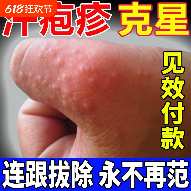 手上起小水泡汗泡疱止痒抑菌中药鹅掌风真菌感染手气湿痒疹专用膏