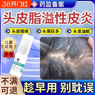 头皮毛囊炎喷雾剂头皮屑脂溢性皮炎药膏头部抑菌喷剂真菌感染头癣