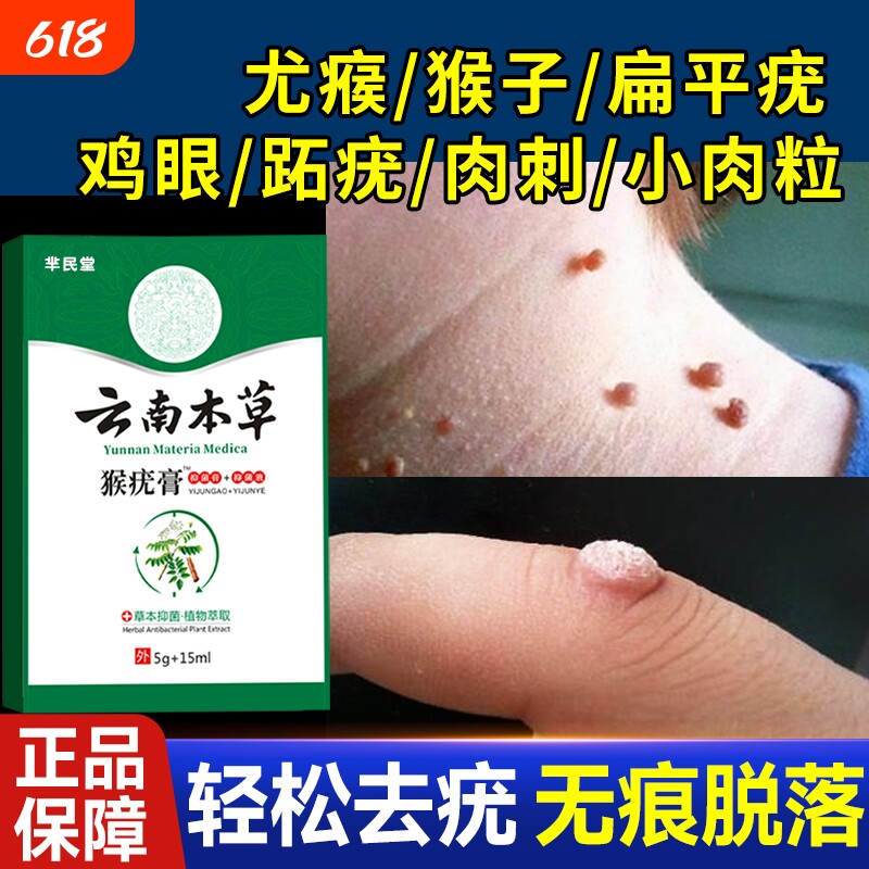 去除尤疣瘊猴子祛除扁平神器脖子上长小肉粒疙瘩一抹无忧灵药膏