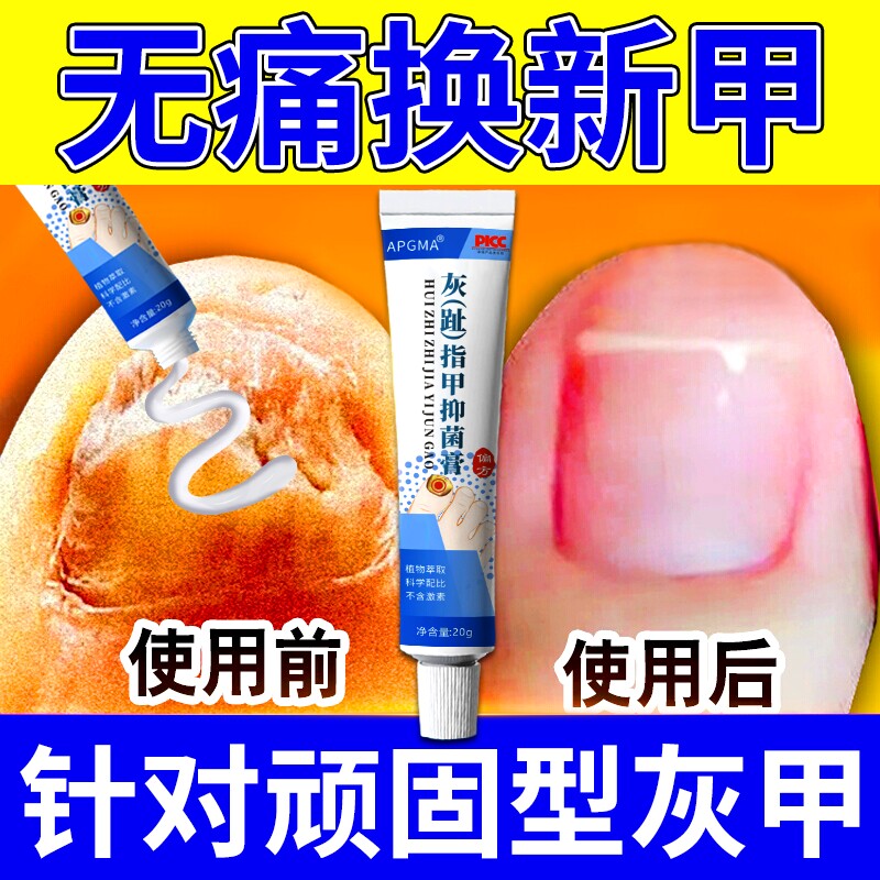 灰指甲专用脱甲膏治甲沟炎真菌感染息肉去除消肿嵌甲正品抑菌液
