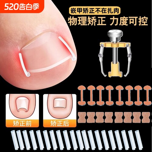 甲沟矫正器嵌甲贴片炎防脚指甲往肉里长专用工具隔离垫片神器趾甲