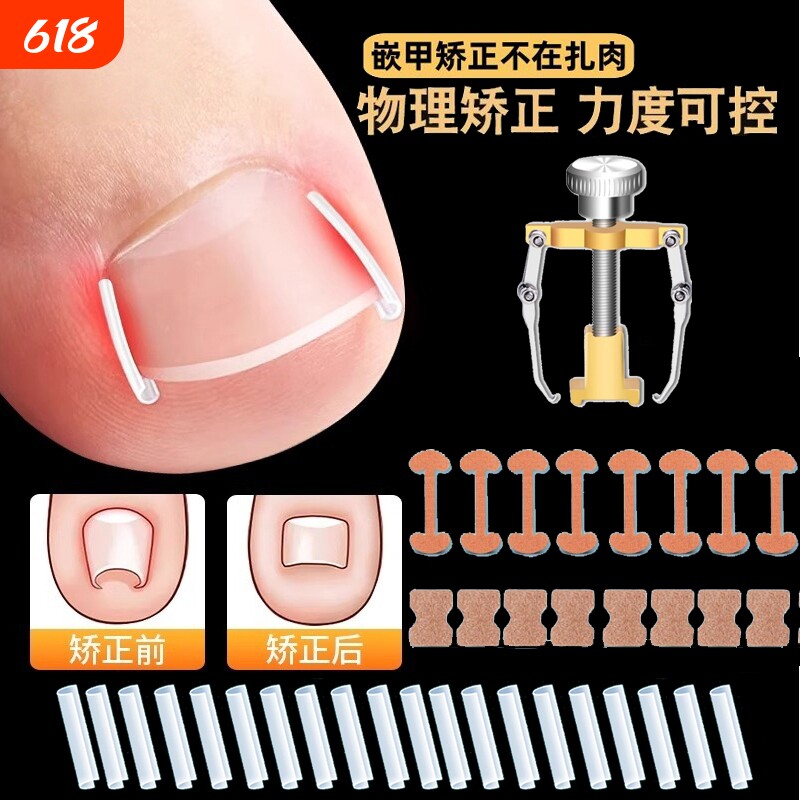 甲沟矫正器嵌甲贴片炎防脚指甲往肉里长专用工具隔离垫片神器趾甲