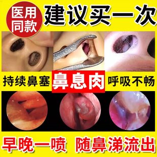 奥惠达 盐酸奥洛他定片常年性季节性过敏性鼻炎鼻塞流涕喷嚏瘙痒