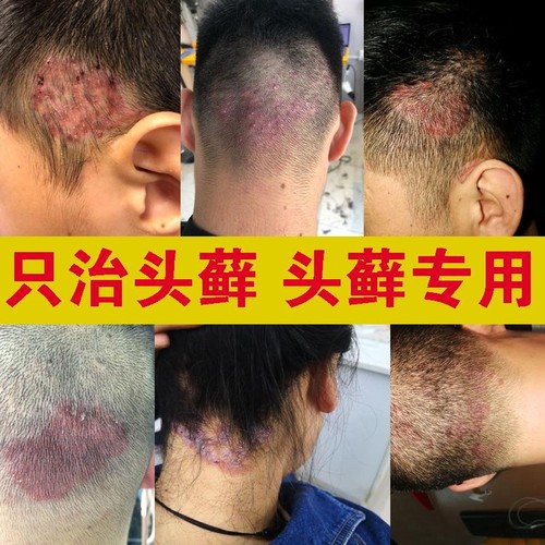 头皮屑头癣的药真菌感染头藓银屑癣头部牛皮癣治疗头皮癣的药膏