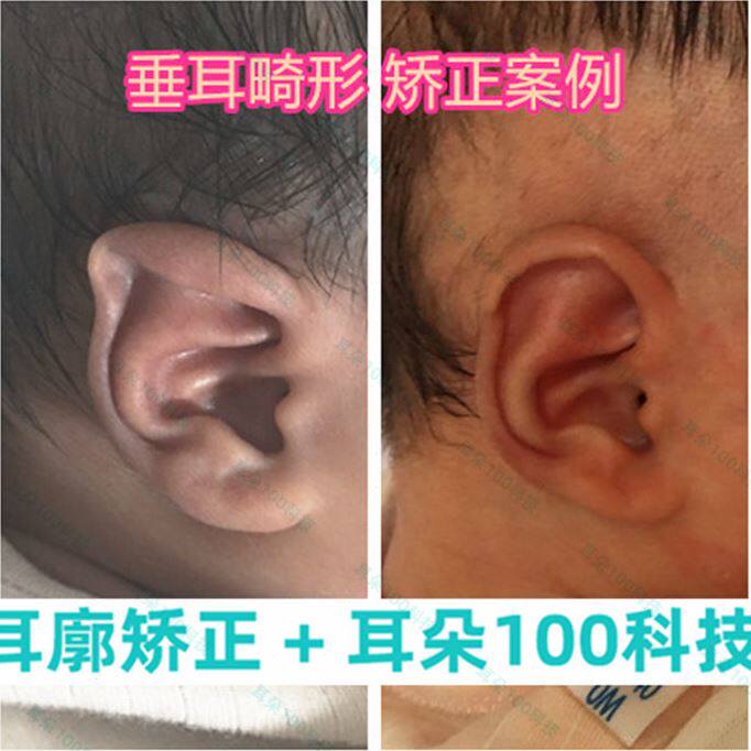 耳朵矫正器婴儿新生儿耳廓畸形矫形宝宝矫纠正器招风耳胶带塑型