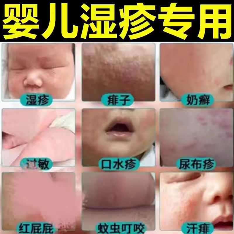 湿疹婴儿专用宝宝奶藓膏口水疹婴幼儿热疹儿童特应性皮炎止痒祛根