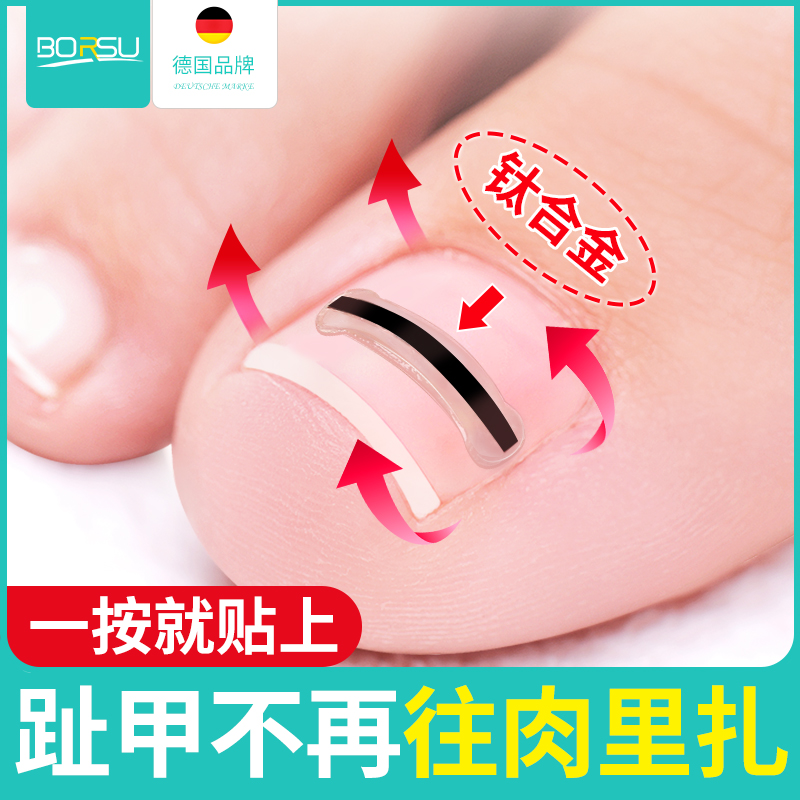 甲沟炎嵌甲矫正器一贴就拉直