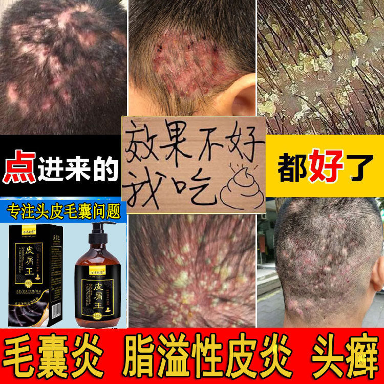 康王去屑止痒头皮癣溢脂性皮炎洗发水