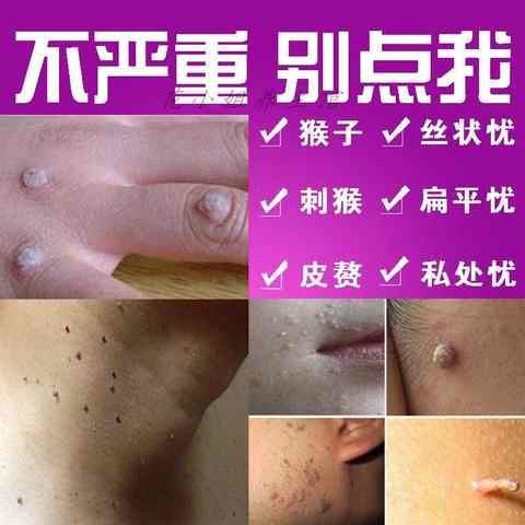 治祛去除脖子腋下小肉粒丝肉疙瘩的药皮肤颈部皮赘肉瘤疣软膏液痣