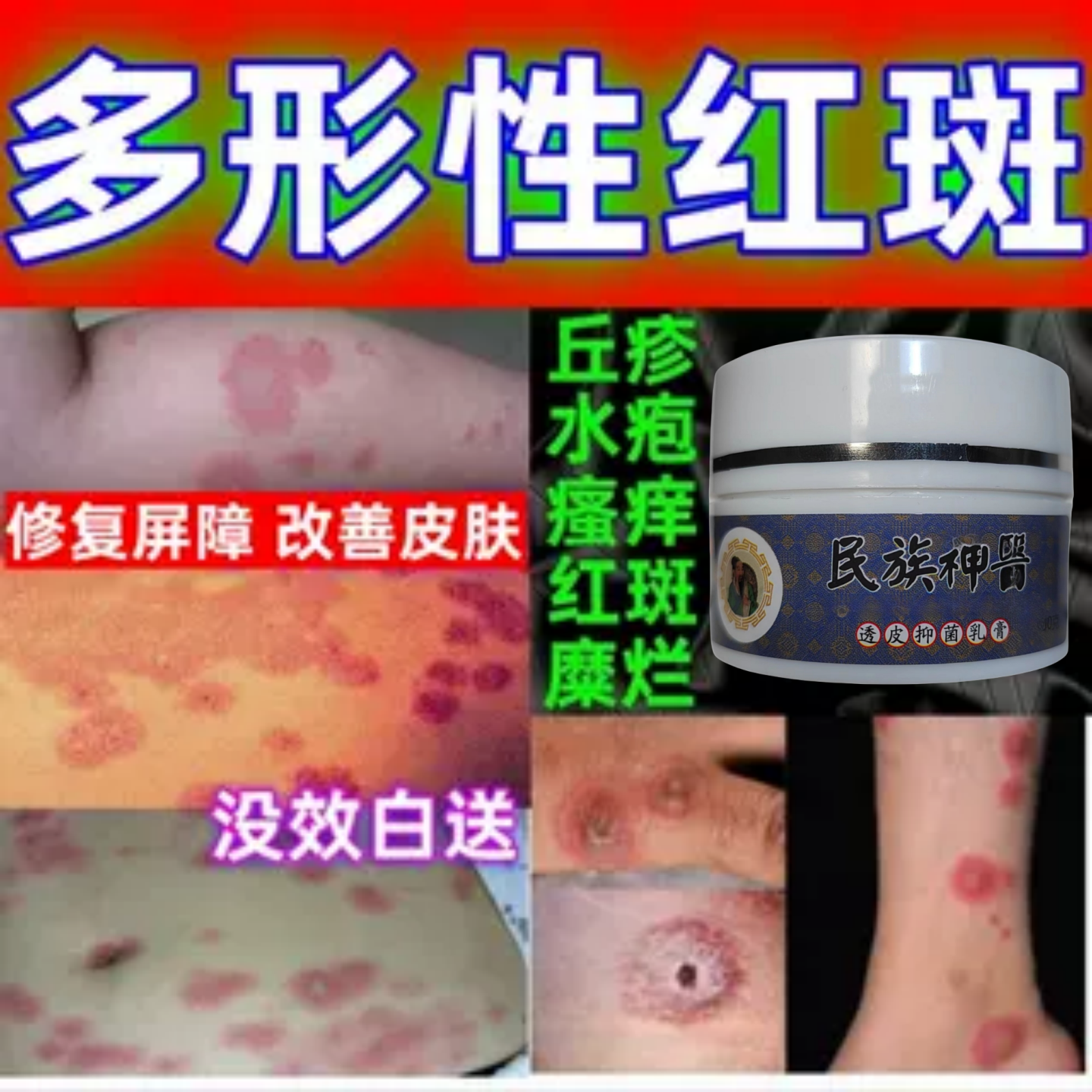 多形性红斑膏丘疹红斑糜烂瘙痒皮肤环状靶形离心性红斑抑菌修复膏