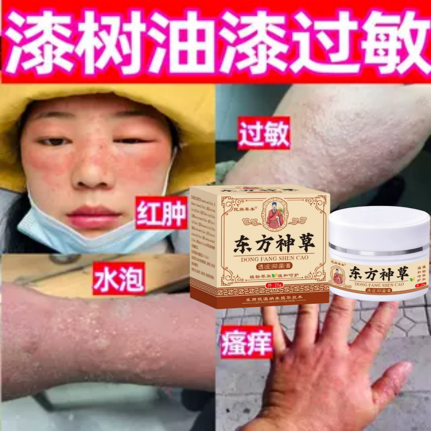 漆树油漆大漆过敏药皮肤过敏红斑红肿瘙痒疙瘩水泡涂抹脱敏修复膏