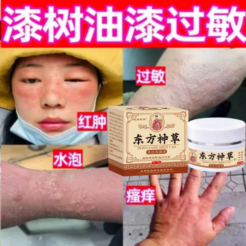 漆树油漆大漆过敏药皮肤过敏红斑红肿瘙痒疙瘩水泡涂抹脱敏修复膏