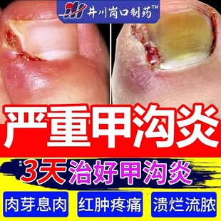 手脚大拇指甲沟炎治疗专用药膏水息肉去除脚趾甲往肉长非特效1mi