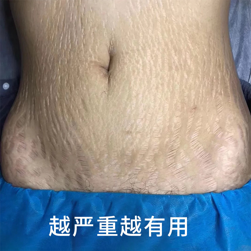 【薇娅推荐】产后无纹 淡化妊娠纹  身体不留一丝痕迹 拍二发三~