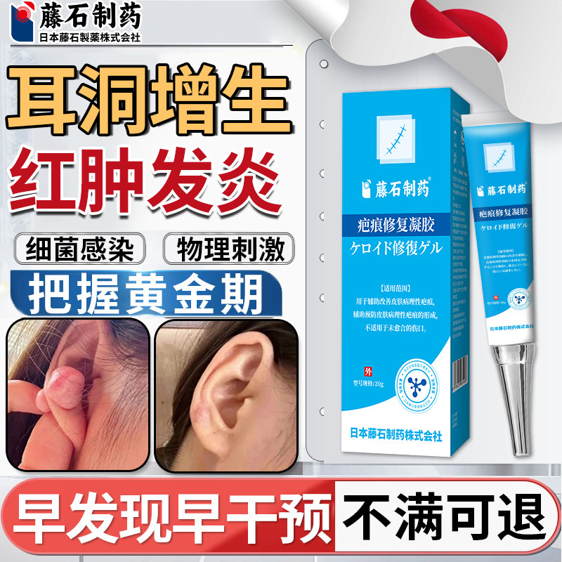 耳洞增生疤痕疙瘩凸起硬肉软化针可搭膏药贴止软化痒乳膏去SE,医疗器械,祛疤产品,淘宝优惠券,粉丝福利购,淘宝优惠卷