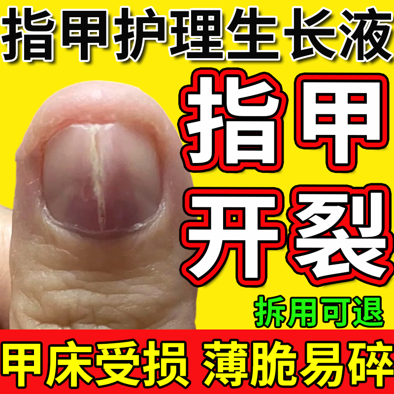 手脚指甲边缘竖纹开裂增厚修复生长液护甲养甲床真菌感染膏药贴CS