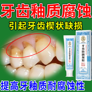 牙釉质腐蚀可搭牙齿楔状缺损修补重度敏感牙髓炎医用非牙膏专用CS