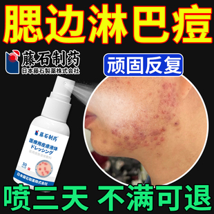 淋巴痘腮边痘专用下巴反复长痘痤疮膏下颚脸上结节硬块痘痘喷剂SE