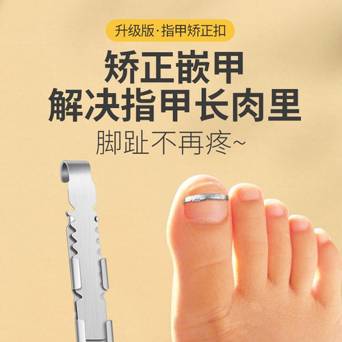 甲沟矫正器嵌甲矫正器脚趾甲卷指