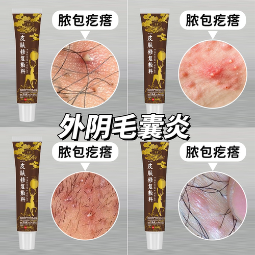 【速发】外阴毛囊炎长小疙瘩瘙痒