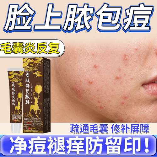 速发】脸上毛囊炎脓包痘痘痤疮膏