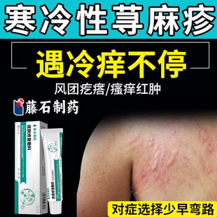 寒冷性慢性寻荨麻疹提高增强免疫力治疗进口过敏药房物止痒专用YS