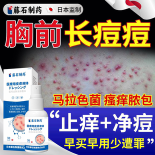 胸前长痘痘喷雾剂胸口毛囊炎红疙瘩前胸后背脖子背上除螨祛痘痒YS