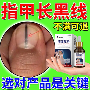 甲母痣指甲上有黑色竖纹长黑线去黑指甲凹凸不平专用淤血灰指甲YS