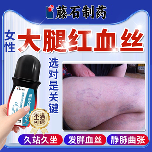 去腿上有红血丝静脉曲张涨冷敷凝胶医用大腿毛细血管扩张紫YS