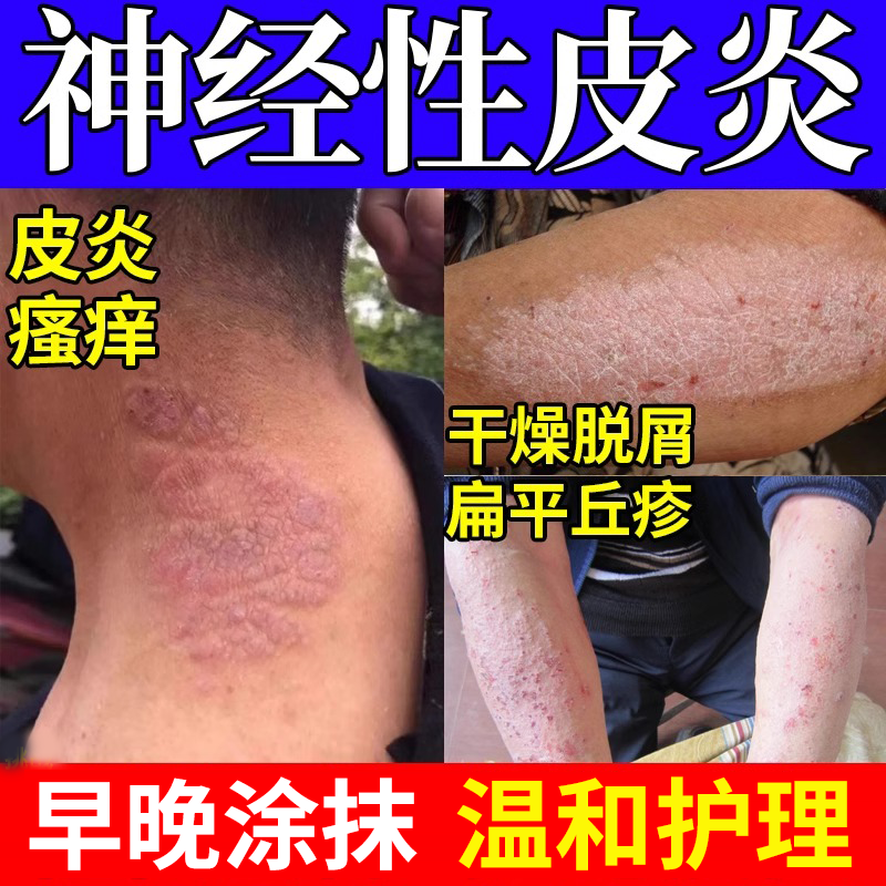 【速发】远离神经性皮炎