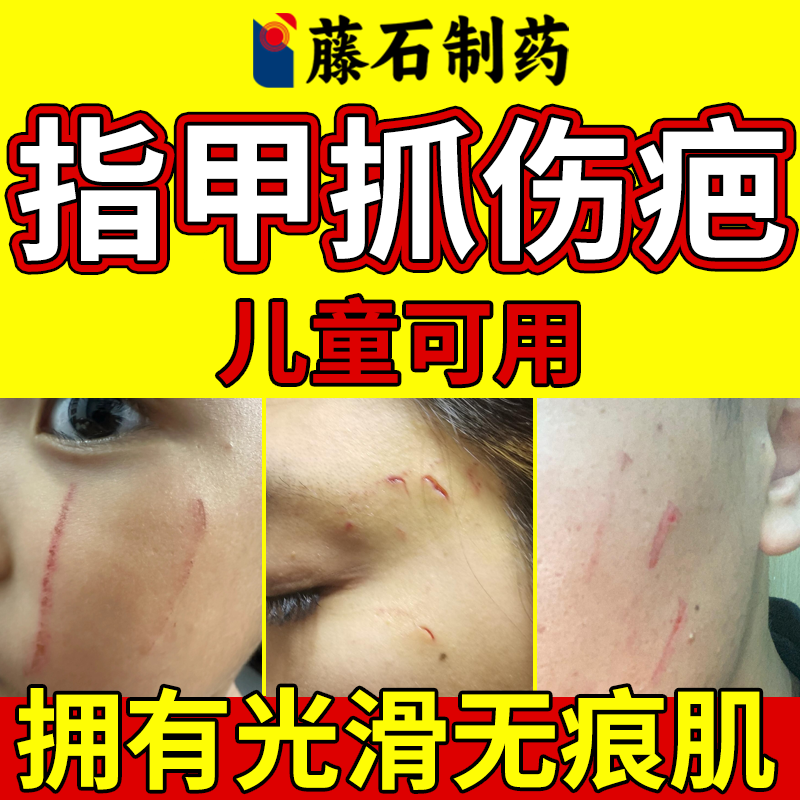 【现货速发】指甲抓伤划伤疤痕膏