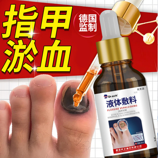 指甲淤血脚指甲被砸夹压伤甲下出血甲床受损发紫坏死再生长液YM