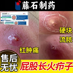 屁股上长火疖子疖肿拔毒膏拔脓膏特消敷料贴硬块炎药房同款膏效YS