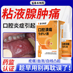 口腔溃疡粘液腺囊块肿痛导管阻塞舌下滤泡异物感长水泡进食困难YY