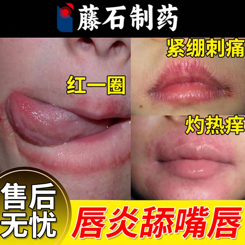 儿童唇炎唇膏嘴唇防干裂脱皮医用型唇周炎专用口唇炎药房同款膏YS