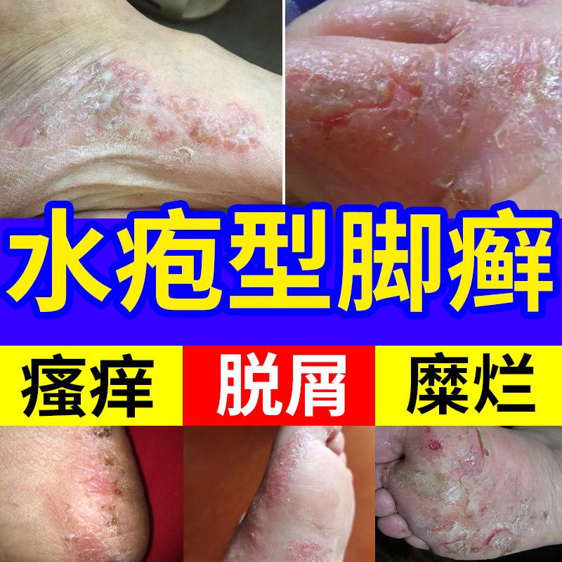 水泡型脚气水疱型足藓脚痒脚癣一次净泡脚足癣喷雾真菌感染脚藓YS