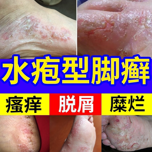 水泡型脚气水疱型足藓脚痒脚癣一次净泡脚足癣喷雾真菌感染脚藓YS