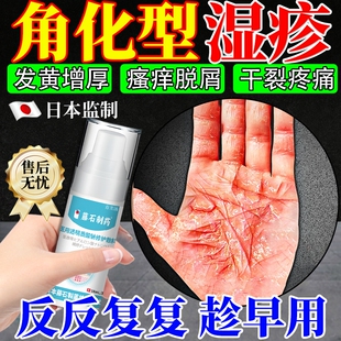 角质化角化型手部湿疹手藓手癣膏脱皮干裂真菌感染开裂药房同款YY