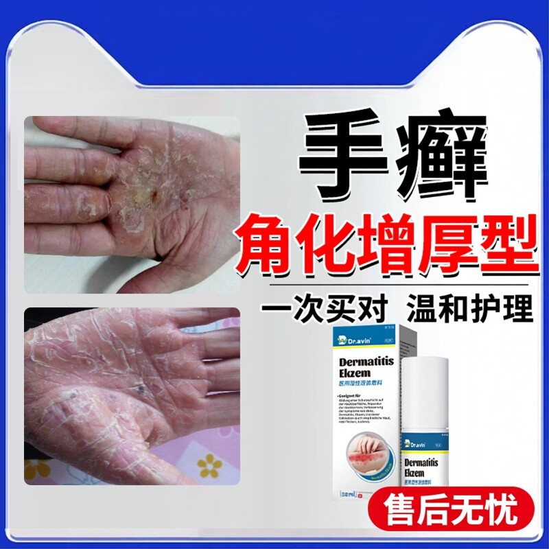 角化型手癣膏脱皮干裂真菌感染湿疹止痒去手足癣藓根鹅掌风烂手YS