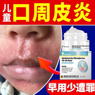 儿童口周皮炎药膏脂溢性面部嘴巴周围长痘痘唇周炎过敏湿疹脸上YS