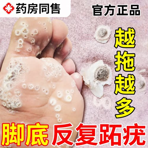 现货速发】脚跖疣黑点拓尤蚩尤膏
