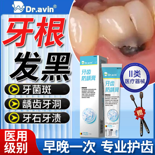 牙根黑三角牙齿牙菌斑黑渍祛除神器牙黑色素沉淀可搭配牙膏用YM