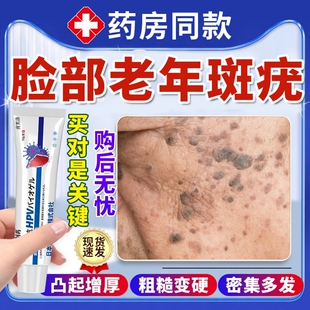 去脸上凸起老年斑老人疣扁平疣脂溢性角化病手背一抹灵去除软膏YS
