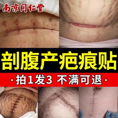 同仁堂剖腹产医用疤痕贴刨腹剖宫破腹刨妇增生疤痕去刀口硅酮凝胶