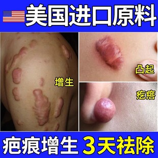 疤痕增生凸起疙瘩去瘢痕剖腹产伤疤可搭除疤去除修复祛疤去疤膏贴